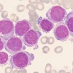 La reproducción excesiva de globulos blancos genera la leucemia