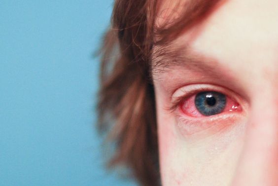 Ojos rojos por dormir con lentes de contacto