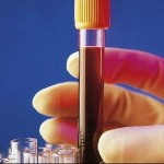 La prueba se sangre es una de los pasos para diagnosticar el lupus